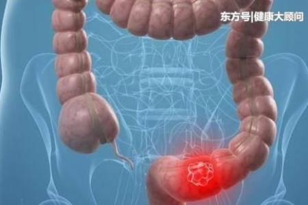 女子听说朋友患肠癌，一查自己也有，他们都有这4个共同点