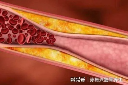 血栓最爱堵在这几些地方，尤其偏爱2类人！速查是否有你