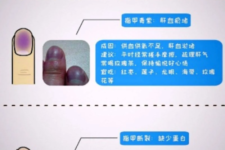 甲状腺好不好，看指甲就知道！这6种变化，都是疾病信号