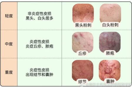 “炎症”不灭全身遭殃！结节|胃病|脱发三大危机逐步拆解！
