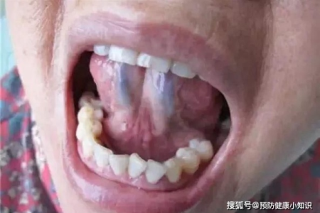 90%心梗脑梗患者的共同特征:舌下青筋暴起!春季血瘀人群必看!