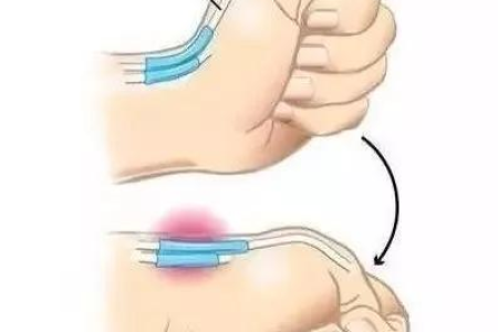 白头翁根能治腱鞘炎吗？试试这个偏方！