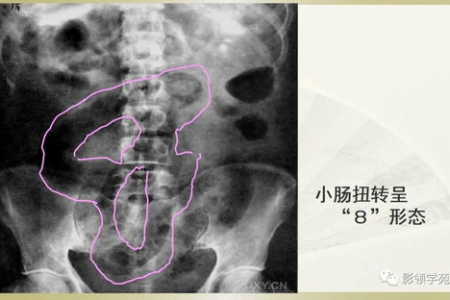 出现这些症状当心肠梗阻：腹痛、呕吐、排便异常怎么办？