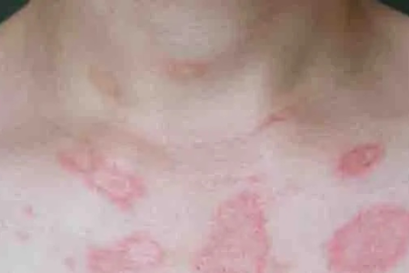 红斑狼疮的症状有哪些？早期症状你了解吗？