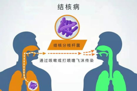想了解肺结核传播途径？告诉你肺结核最主要的传播方式