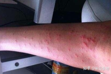 我感染了艾滋病，会有哪些症状？不同阶段症状有何差异？