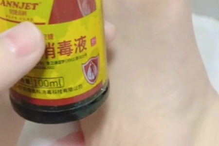 脚气用碘伏消毒管用吗？碘伏能否治愈脚气？