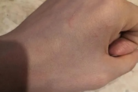 被没出过门的猫抓破皮出血，要不要紧？