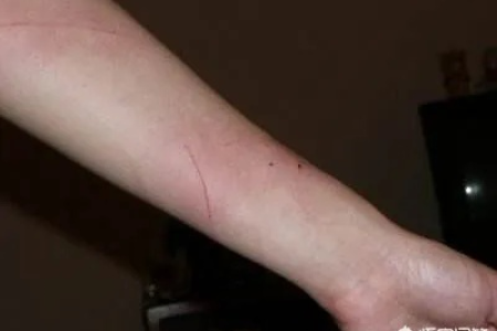 被猫抓伤了，超过24小时还能打针吗？疫苗注射时间的影响有多大？