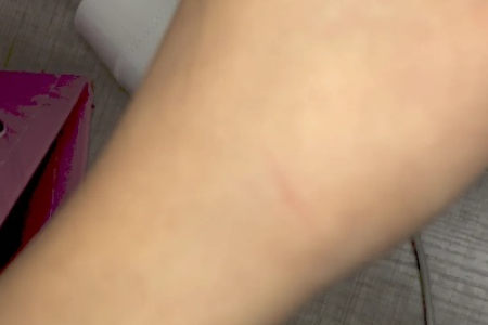 被猫抓出划痕伤口鼓起来，是不是要打疫苗？