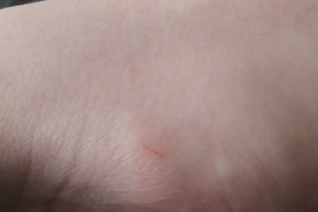 小猫抓伤后肿了，需要打狂犬疫苗吗？如何处理？