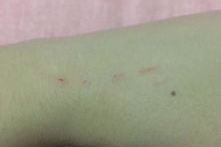 野猫抓伤出血一点点，要不要打狂犬疫苗？
