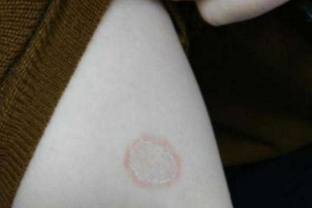 猫藓会传染给人吗？几率有多大？如何预防？