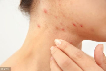 人对猫过敏是什么症状？皮肤痒、打喷嚏算吗？