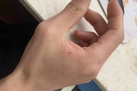 被打过狂犬疫苗的猫抓了，要不要再打针？