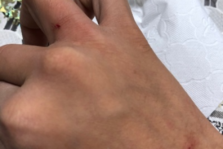 被两个月小猫咬伤，该不该去医院打针？