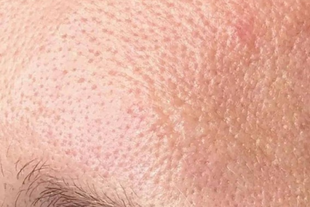 额头毛孔粗大皱巴巴怎么办？皮肤性病科有妙招