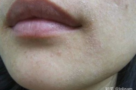 脸上皮肤干燥起皮像鱼鳞，内分泌科如何治疗？