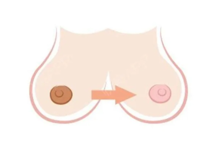 少女乳晕大是病吗？未婚女性乳晕大的原因及应对