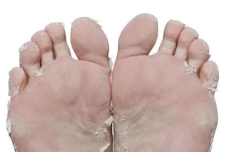 皮肤性病科治疗脚底脱皮，哪种方法最快最有效？经验分享