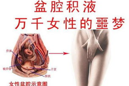 子宫直肠陷凹积液多少才算正常？妇科医生权威解答