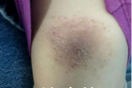 皮肤性病科医生告诉你：女生腿上无缘无故淤青的常见原因