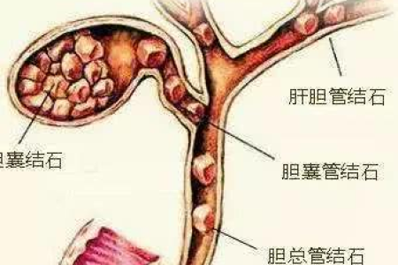 肾内科结石治疗：选择最适合你的方法，快速有效！