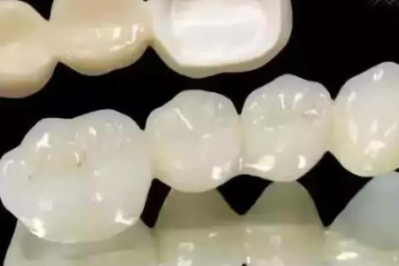 口腔科：烤瓷牙和全瓷牙的优缺点对比，哪个更好？