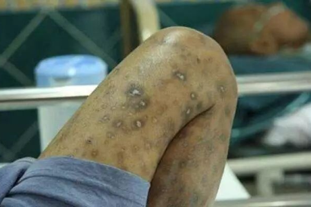 关于艾滋病的传染病分类，皮肤性病科权威解读