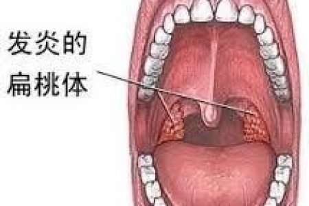 孩子扁桃体肥大，耳鼻喉科手术是必须的吗？