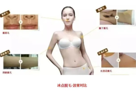 冰点脱毛和超冰点脱毛哪个更好？彻底搞懂两者区别！