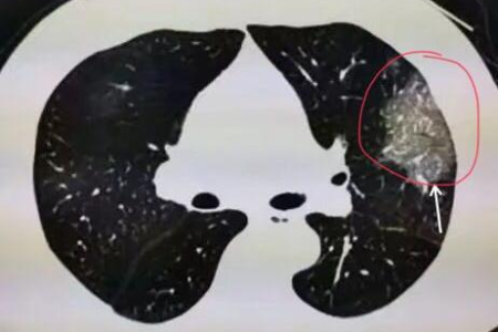 人偏肺病毒引起的烧多久能退？专家权威解读