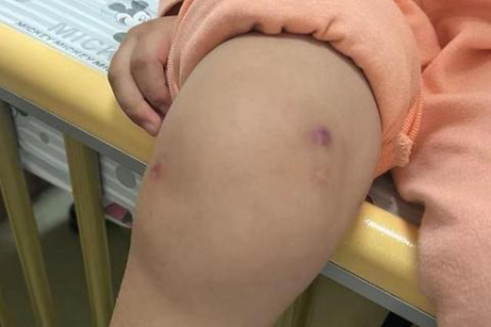 自己在家怎么处理骨科脚扭伤？哪些情况需要去医院？