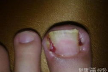 指甲上有小白点，是皮肤性病科的常见问题吗？如何预防和治疗？