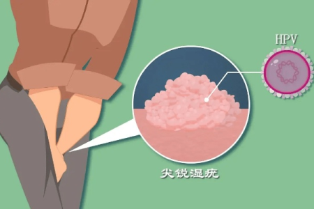 男性生殖感染尖锐湿疣：对女性的危害有多大？