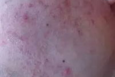 想彻底治好皮肤性病科炎症痘痘？医生教你几招