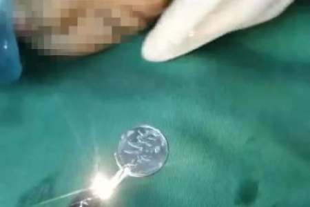 小孩误吞硬币怎么办？儿科医生教你如何应对