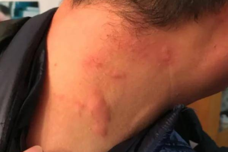 冷空气过敏皮肤病怎么快速治疗？皮肤科医生支招