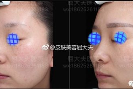 点阵激光美容：有哪些神奇的功效？值得尝试吗？