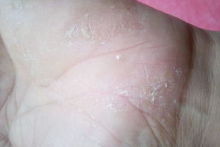 急！脚上起小水泡又痒又难受，皮肤性病科怎么治？