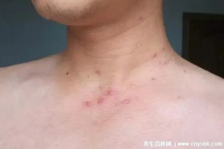 艾滋病感染初期症状是什么？皮肤性病科专家解答你的疑问