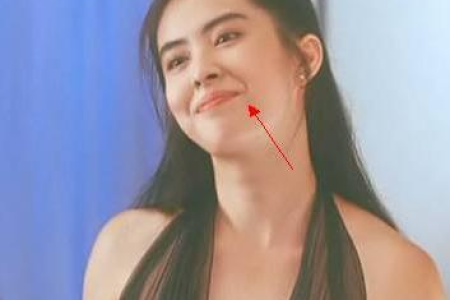 下颌、鼻唇沟、颏部自体脂肪移植：年轻态的秘密武器