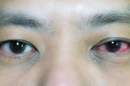 眼科眼白充血怎么消除最快？医生教你几招！