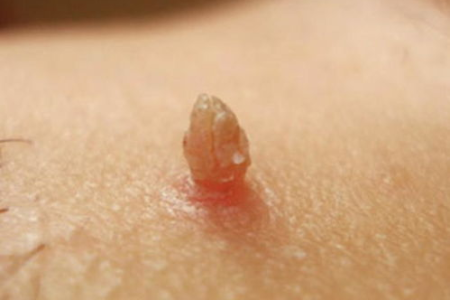 皮肤性病科：脖子上长了几个肉疙瘩是什么原因？