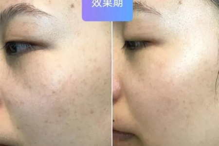 超皮秒祛斑与激光祛斑有什么不同？哪个更适合你？