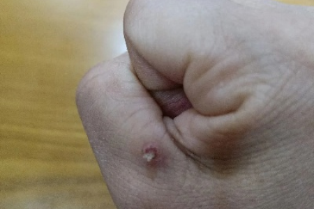 肉痣上用克疣液刺痛，多久能好？需要停药吗？