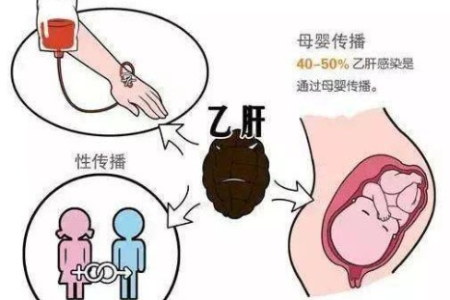 家人有乙肝，小孩子会传染吗？消化内科专业分析