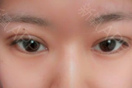 双眼皮手术后变成一个双眼皮一个三眼皮怎么办？