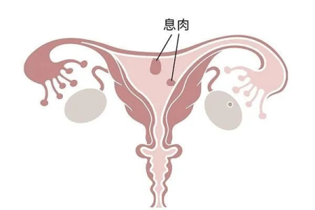 妇科宫腔息肉，哪些情况必须手术？