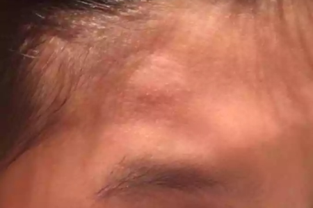 为什么我的额头上长了很多小头发？皮肤性病科能解决吗？